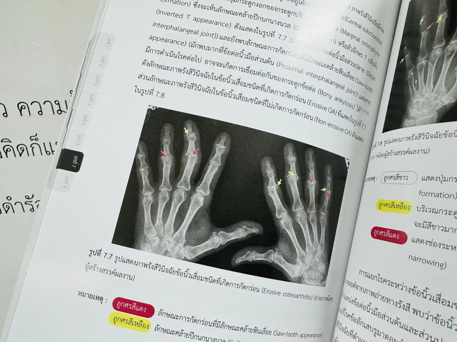 Arthritis