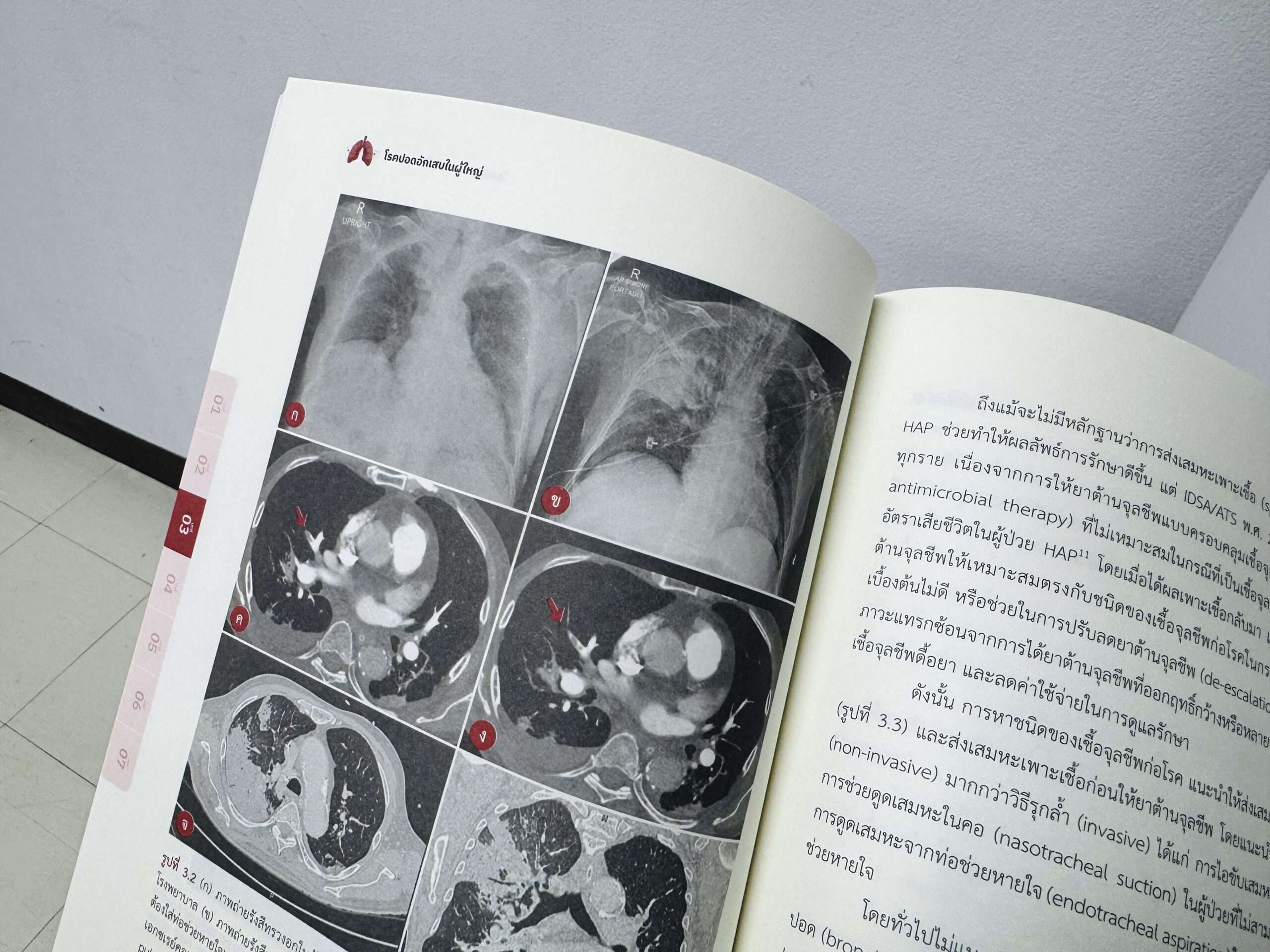 Pneumonia_5310 ปอดอักเสบ