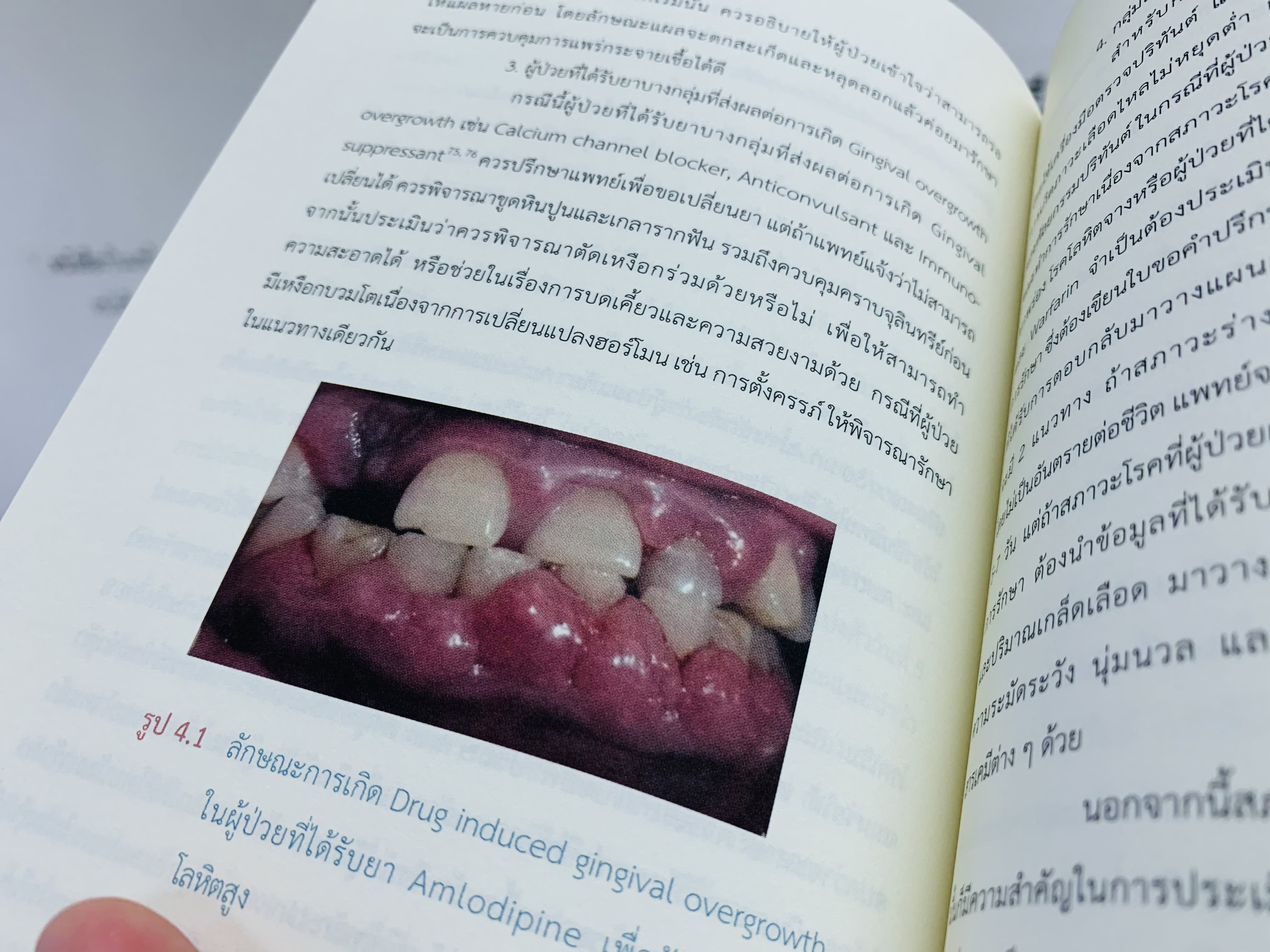 การวินิจฉัยโรคปริทันต์แบบใหม่และการวางแผนการรักษา_6